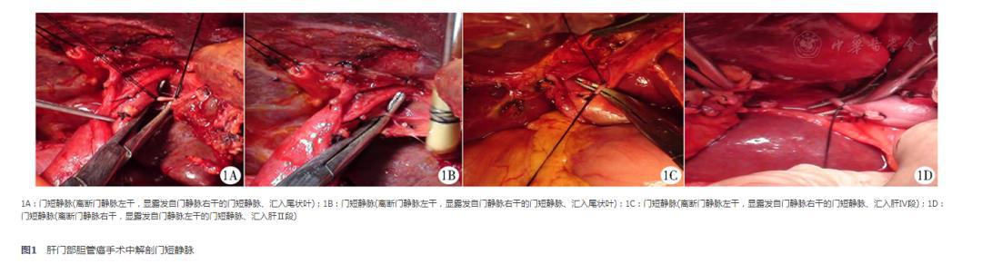 由于"门短静脉"肝外行程普遍极短,大多紧贴门静脉壁,隐藏于肝脏横沟内