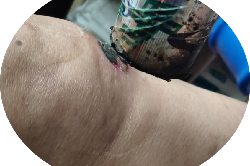 灸疮一发祛病如抓,发生灸疮排病的效果更好