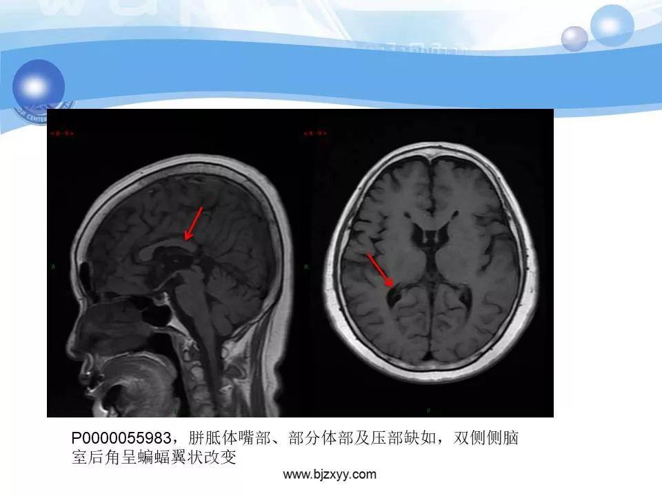 胼胝体发育不良的影像诊断