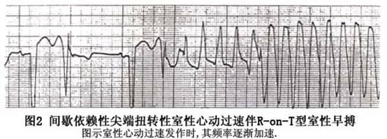 临床必备猝死预警心电图分析