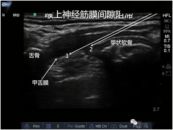 圖22:喉上神經阻滯長軸掃查切面超聲圖像:路徑1,直接注射在甲舌膜表面