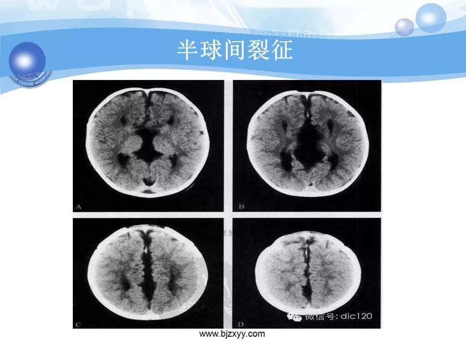 胼胝体发育不良的影像诊断