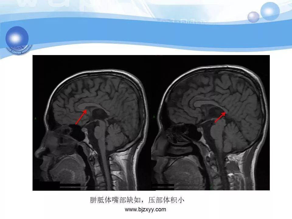 胼胝体发育不良的影像诊断