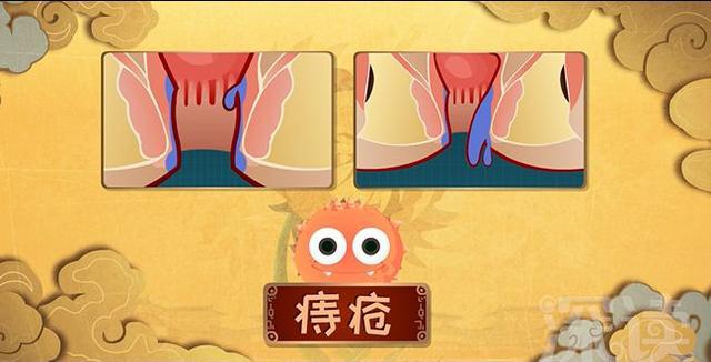 擦屁股的姿势不对小心痔疮找上门预防痔疮该怎么做