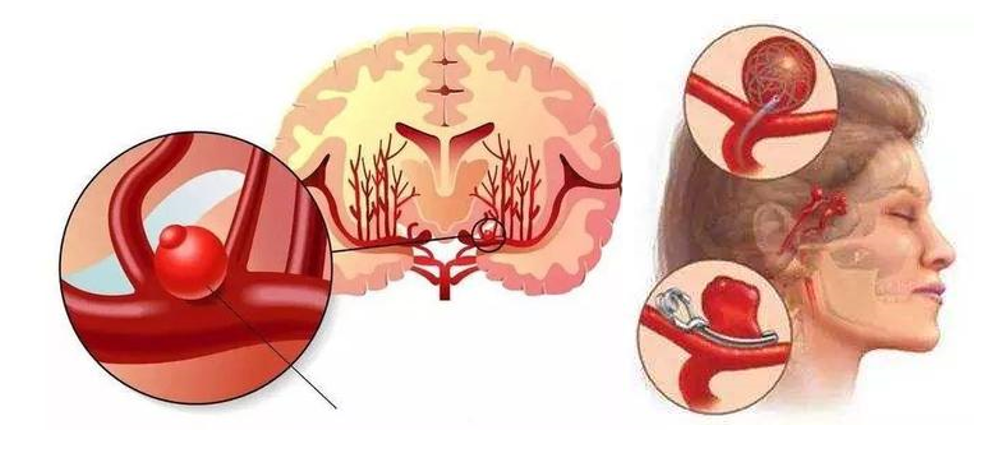颅内动脉瘤示意图图片