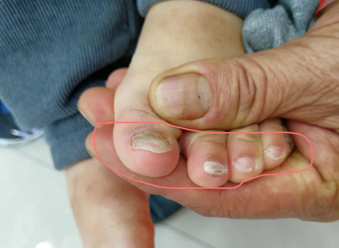 儿童灰指甲初期图片