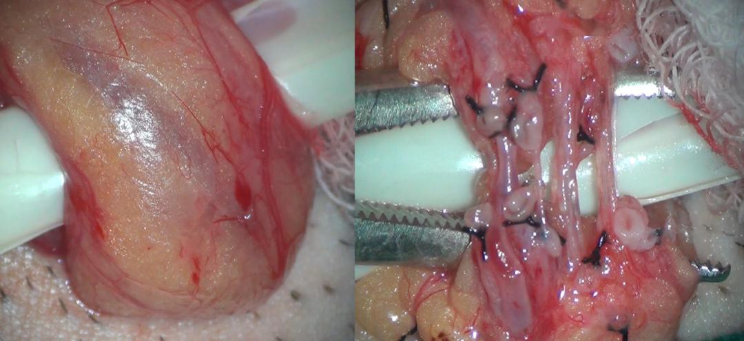 输精管结扎术切除图片