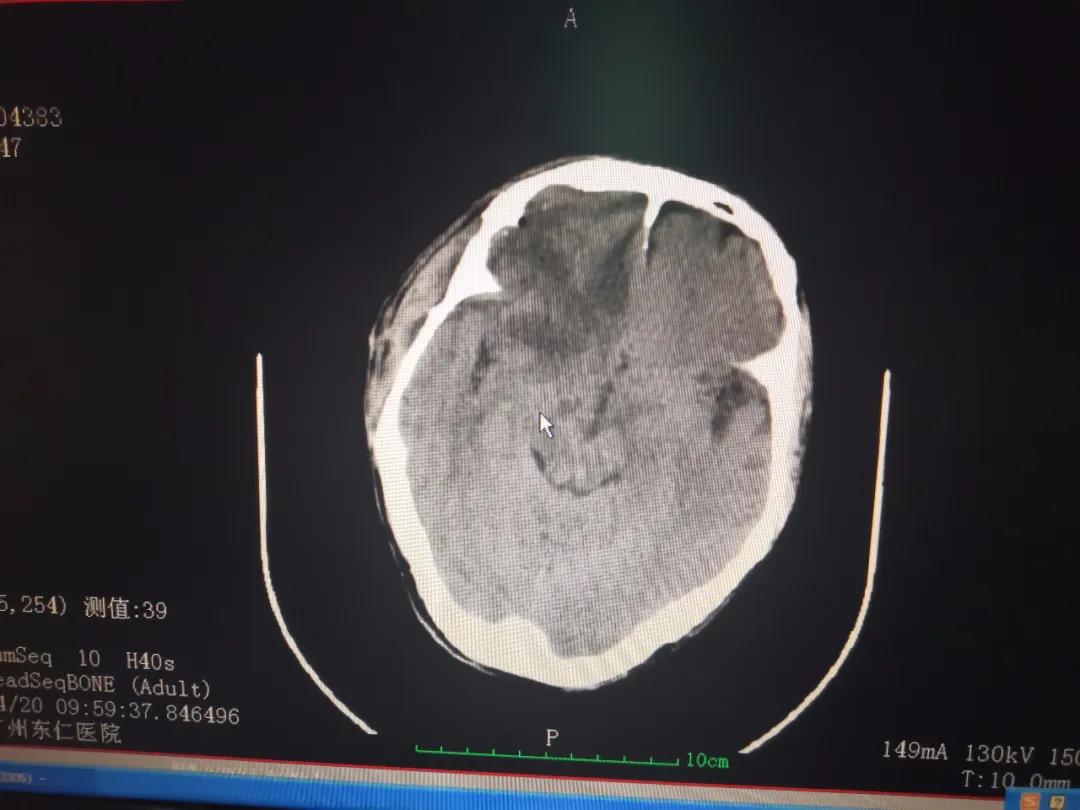 化险为夷-广州东仁医院成功救治一名重型颅脑损伤患者