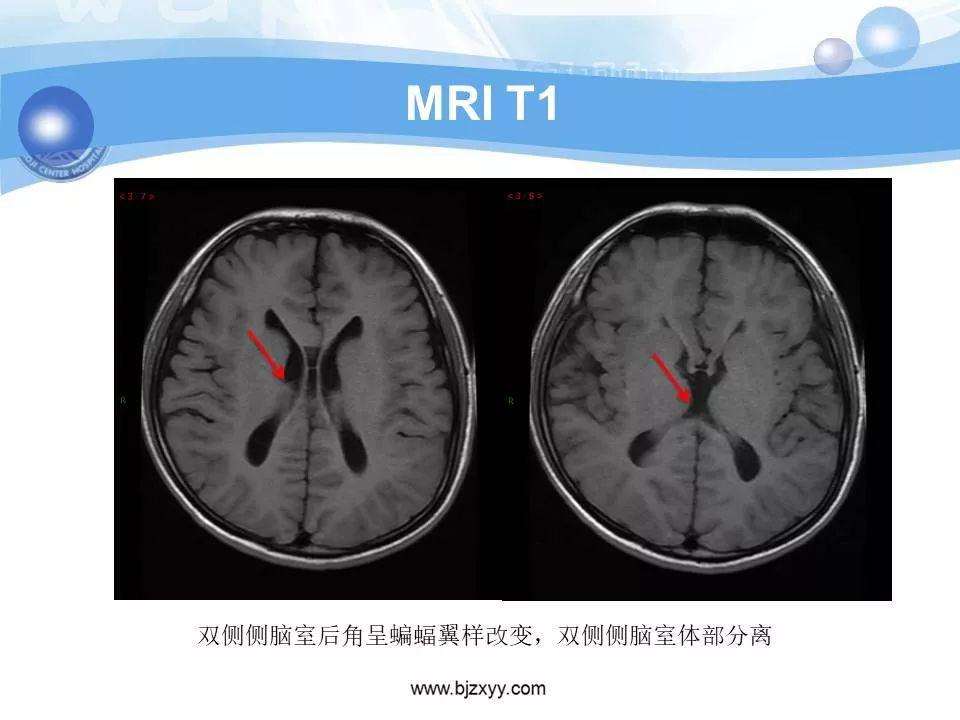 胼胝体发育不良的影像诊断