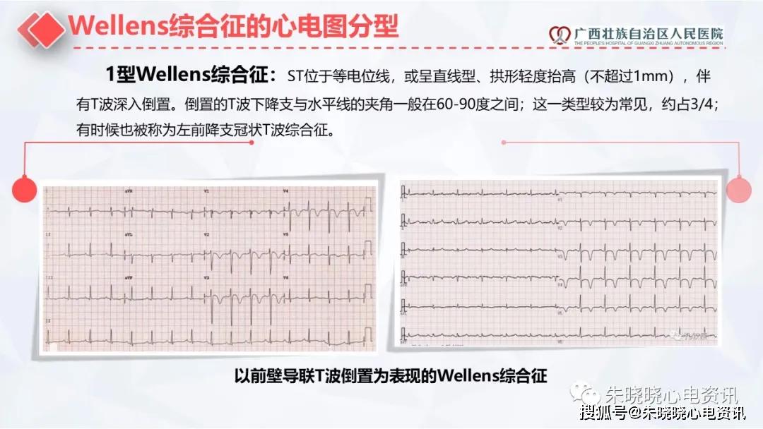 wellens综合征图片