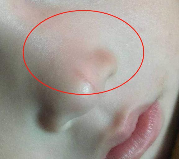 婴儿口鼻周围发青图片图片
