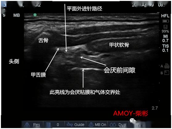 超声专题超声引导喉上神经阻滞的临床实战思维
