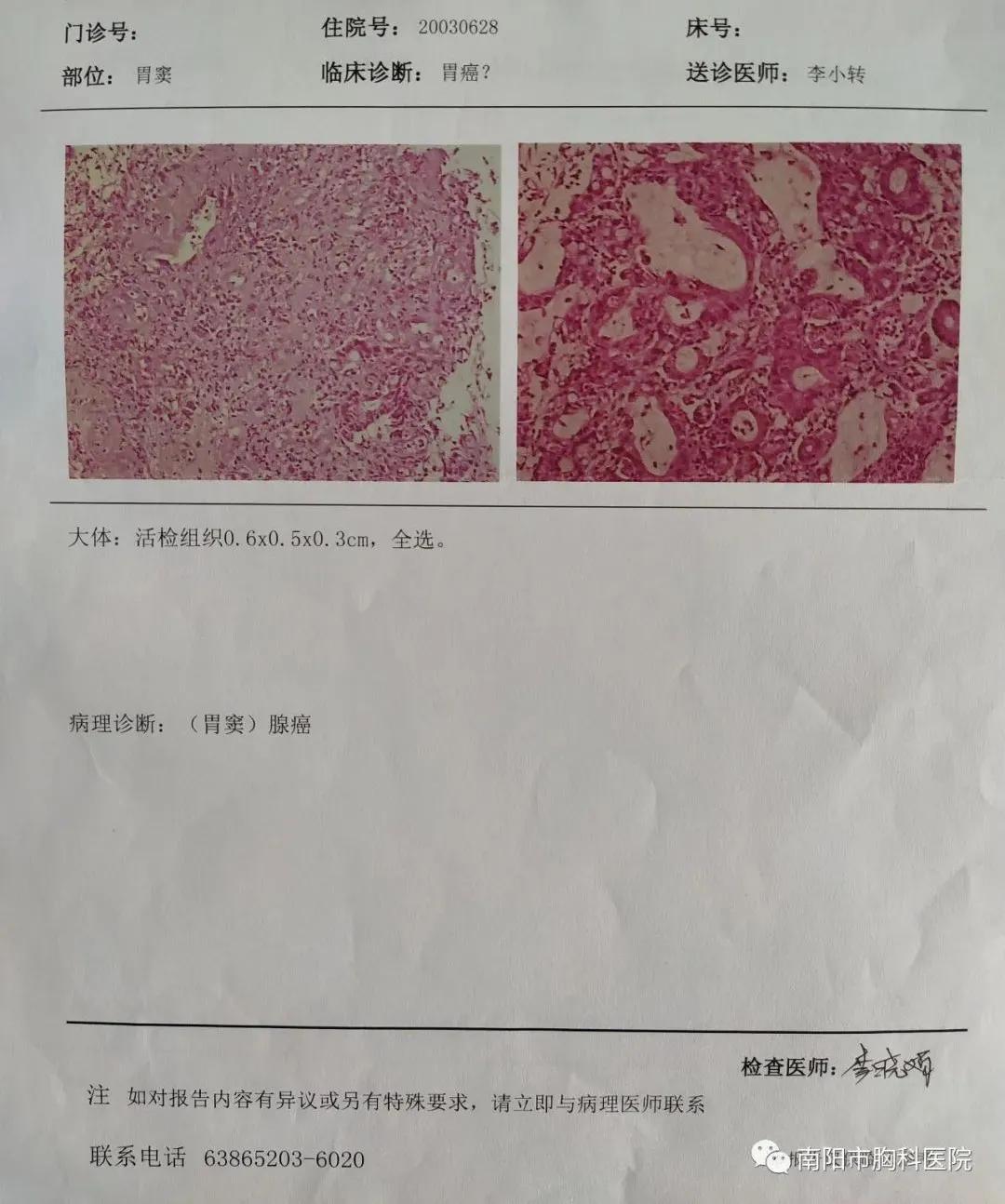 根据胃镜及病理化验回示:胃窦部腺癌诊断明确.