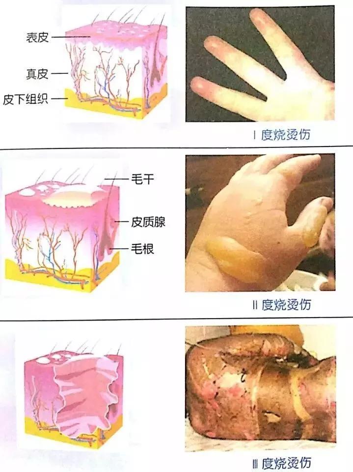 颐和课堂老年人烫伤的正确处理方式