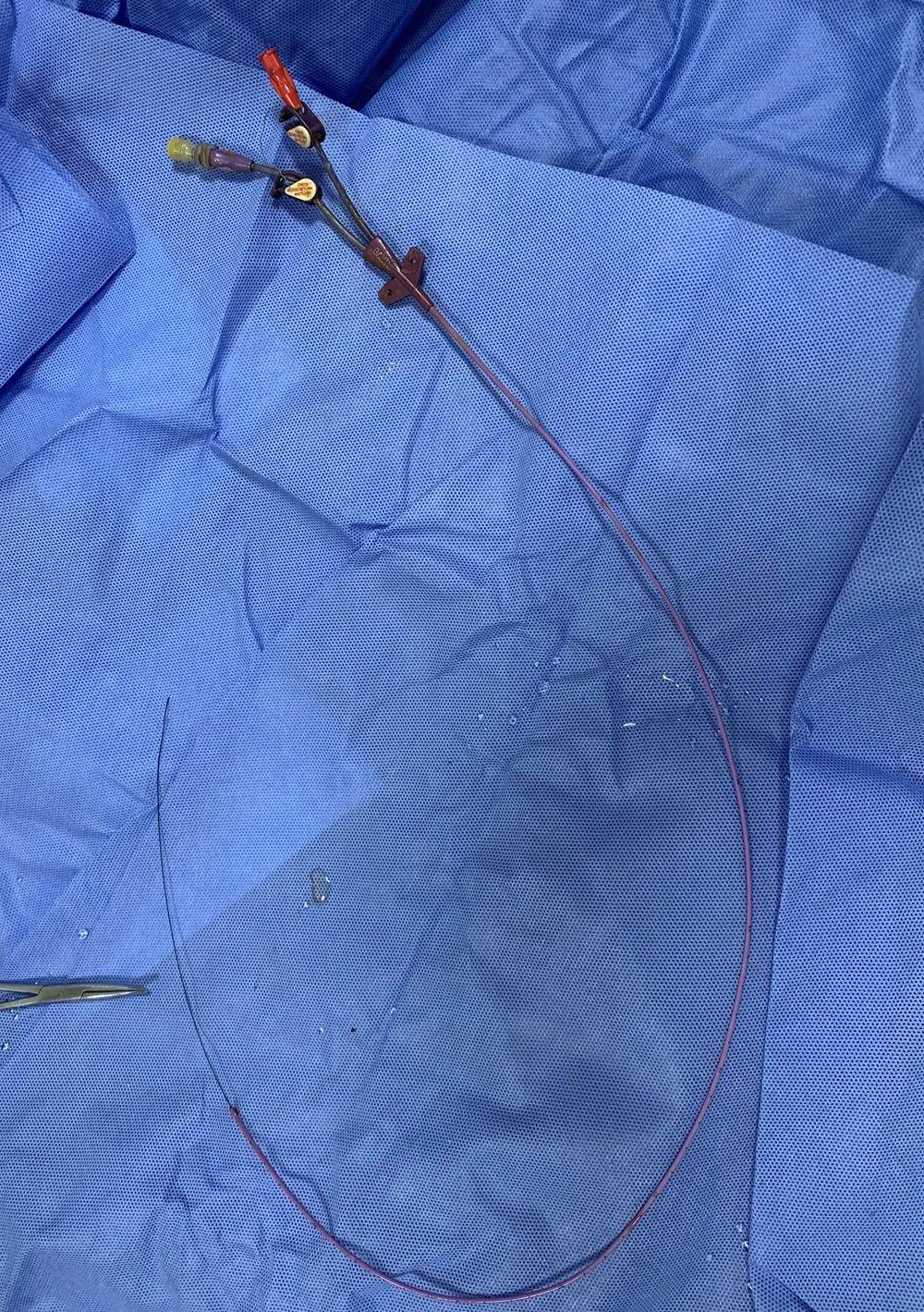 疑难滞留picc管添堵金山医院介入治疗疏通生命通道