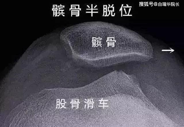 医生让她拍了一个髌骨轴位片,可以看到髌骨位置不正,向外侧倾斜.