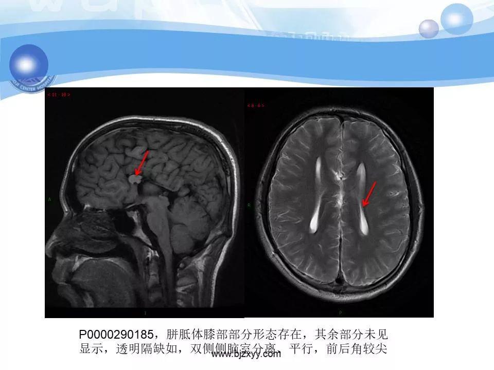 胼胝体发育不良的影像诊断