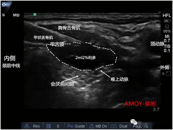 甲状软骨超声图像图片