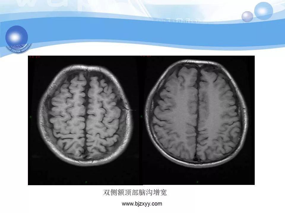 胼胝体发育不良的影像诊断