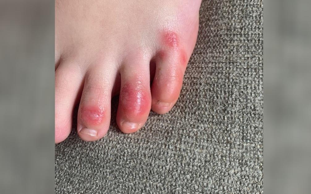 新冠症状又有新发现:医学专家提醒小心脚趾,尤其是孩子!