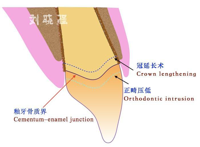 数字技术辅助的美学区牙周修复联合治疗—刘晓强副教授_牙龈