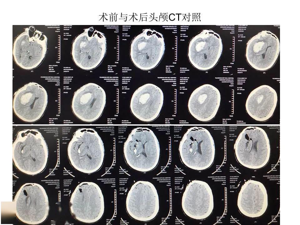 查體:意識不清,一側肢體活動障礙;頭顱ct提示右側基底節區腦出血(40ml