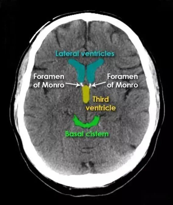 超赞的高清颅脑ct解剖彩色图谱_lateral