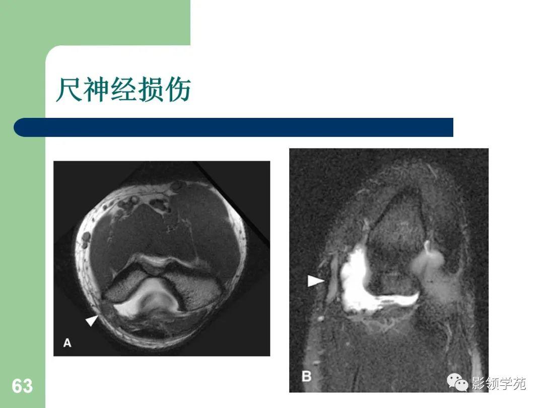 肘关节mri临床应用