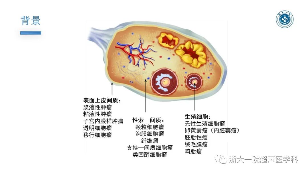 探囊取悟卵巢囊腺瘤的超聲診斷