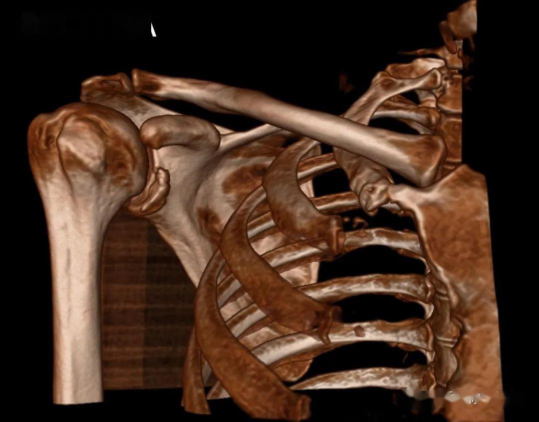 上肢在人体动作的非凡意义---本文图片均为sectra真人三维重建