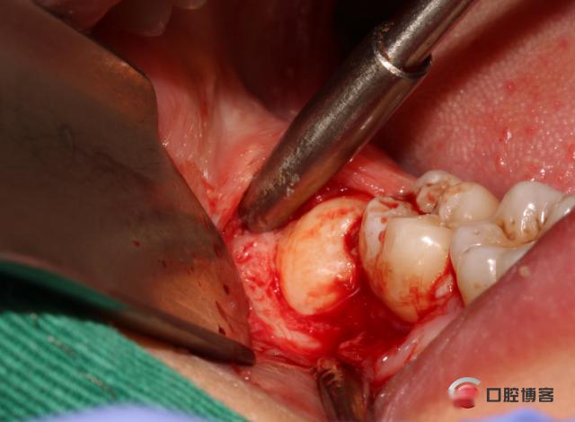 復工拔除下頜雙側智齒