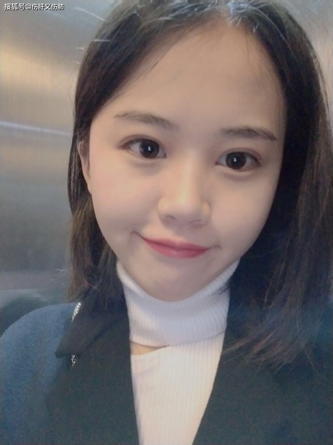 整容初体验,半肋隆鼻恢复过程分享,乖乖女秒变成熟女