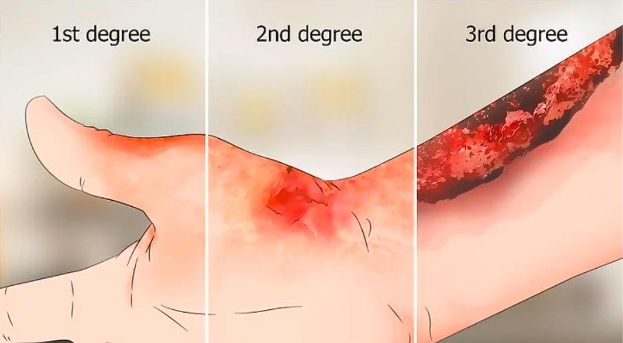 孩子烧烫伤时,冲泡一定有好处吗?要注意什么?