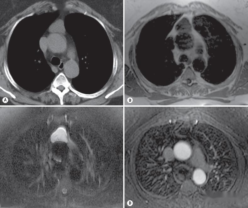 格艾选读丨纵隔疾病相关知识点1