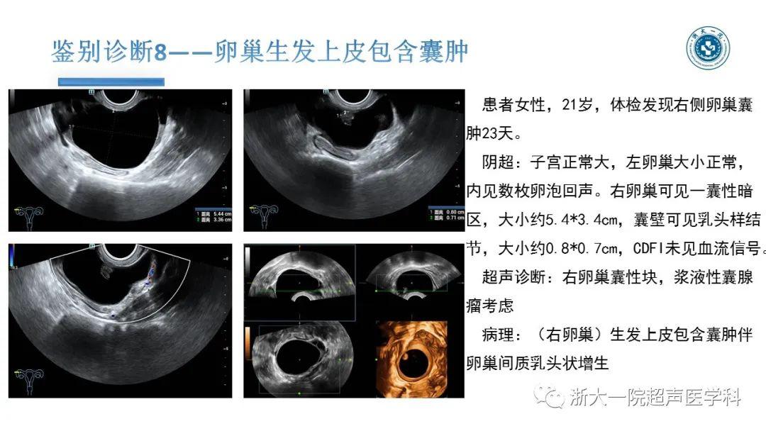 探囊取"悟"——卵巢囊腺瘤的超声诊断_何蒙娜