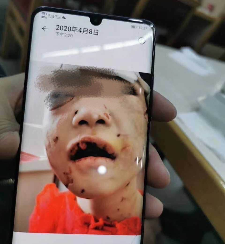 网曝黑龙江佳木斯建三江管局创业农场,后妈虐打儿童,用剪刀把孩子的