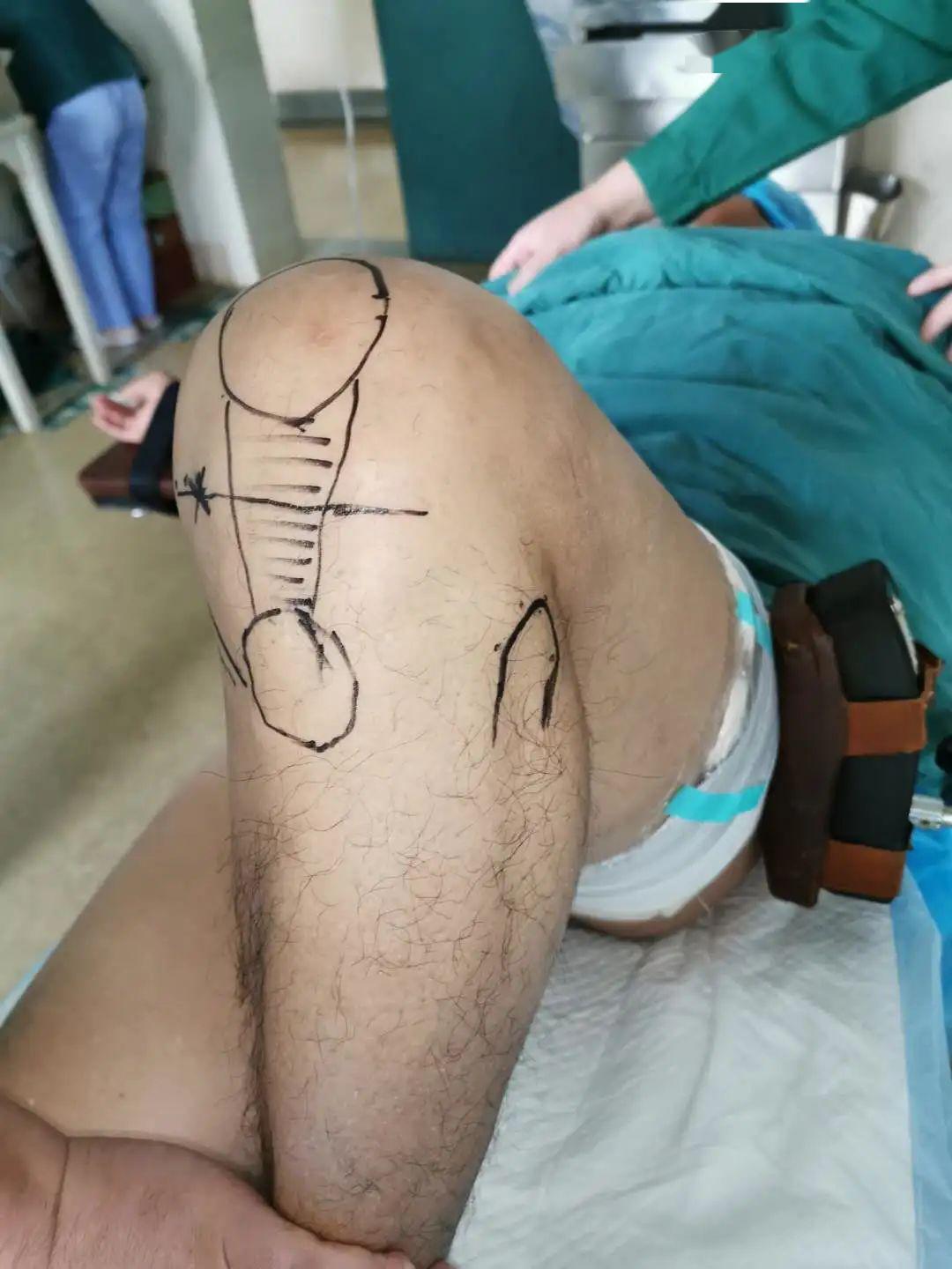 【医疗技术】我院首例截骨矫形保膝手术成功开展