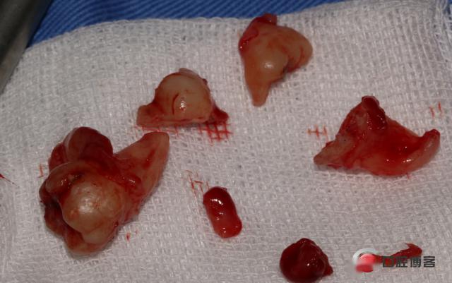 盲袋顺势切除;冠周牙囊记得清理干净;大量生理盐水冲洗后;双侧填上cgf