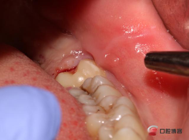 复工拔除下颌双侧智齿