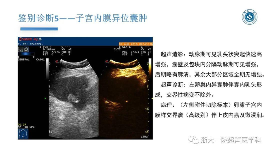 探囊取悟卵巢囊腺瘤的超声诊断