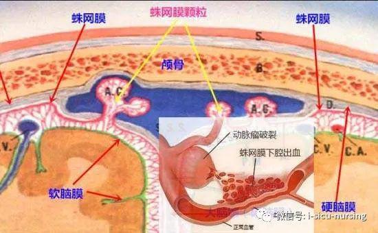 蛛网膜下腔出血有多严重