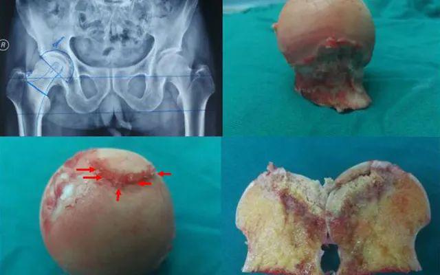 专家答疑股骨头坏死不同时期塌陷防治的重要意义