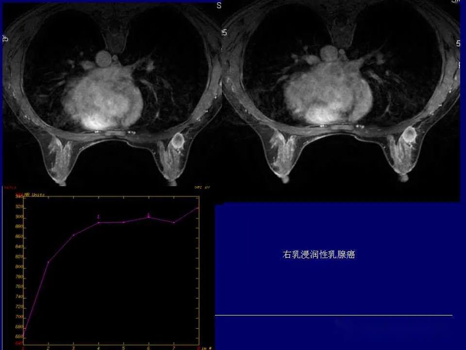 乳腺癌磁共振图片图片