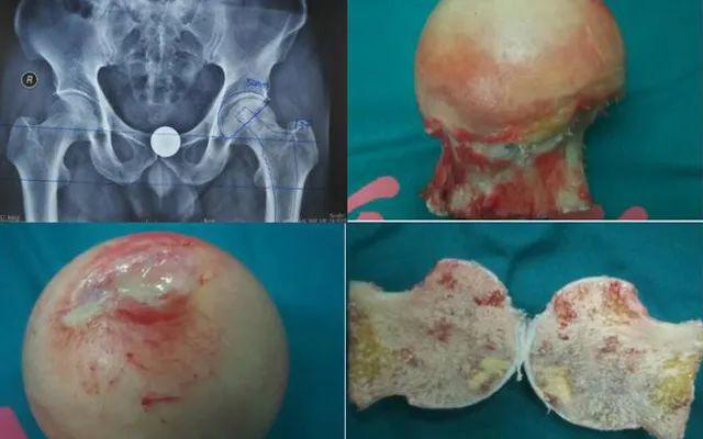 【专家答疑】股骨头坏死不同时期塌陷防治的重要意义!