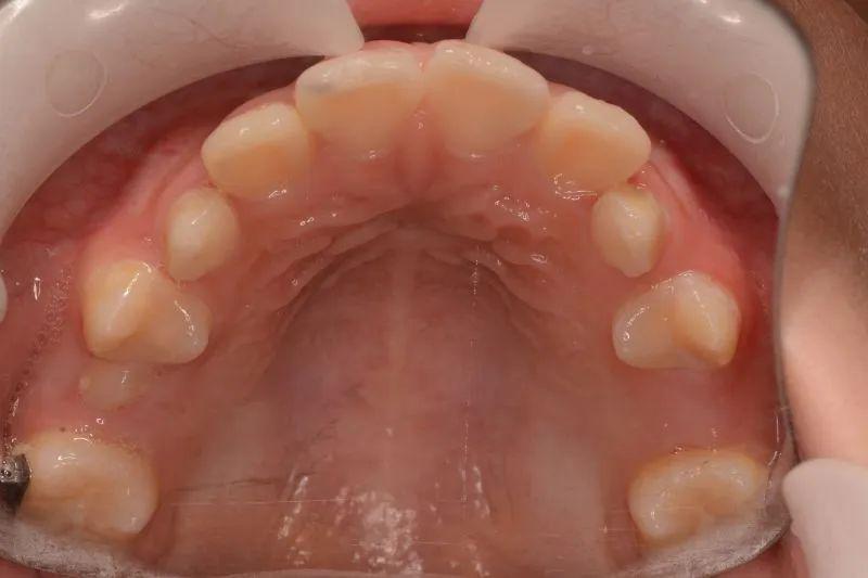 儿童早期矫治的辨析和治疗策略厉松教授