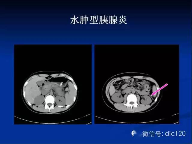 儿童常见急腹症的影像诊断(下)