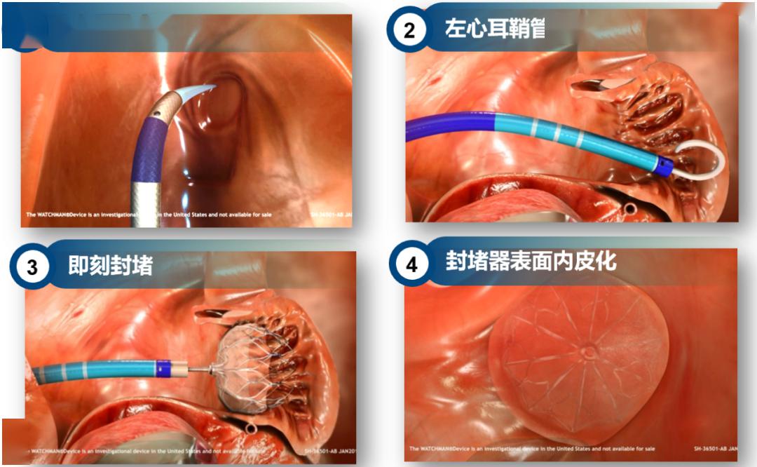 左心耳封堵术适应症图片