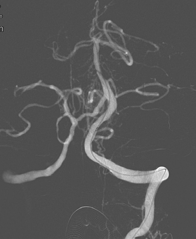 擔心穿支血流受影響球囊擴張左側椎動脈造影提示:基底動脈重度狹窄查