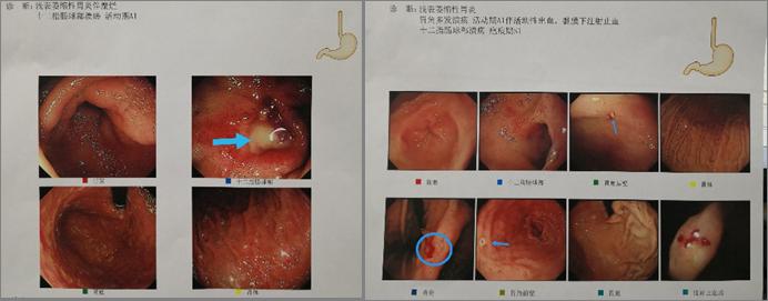 大便颜色知多少黑便