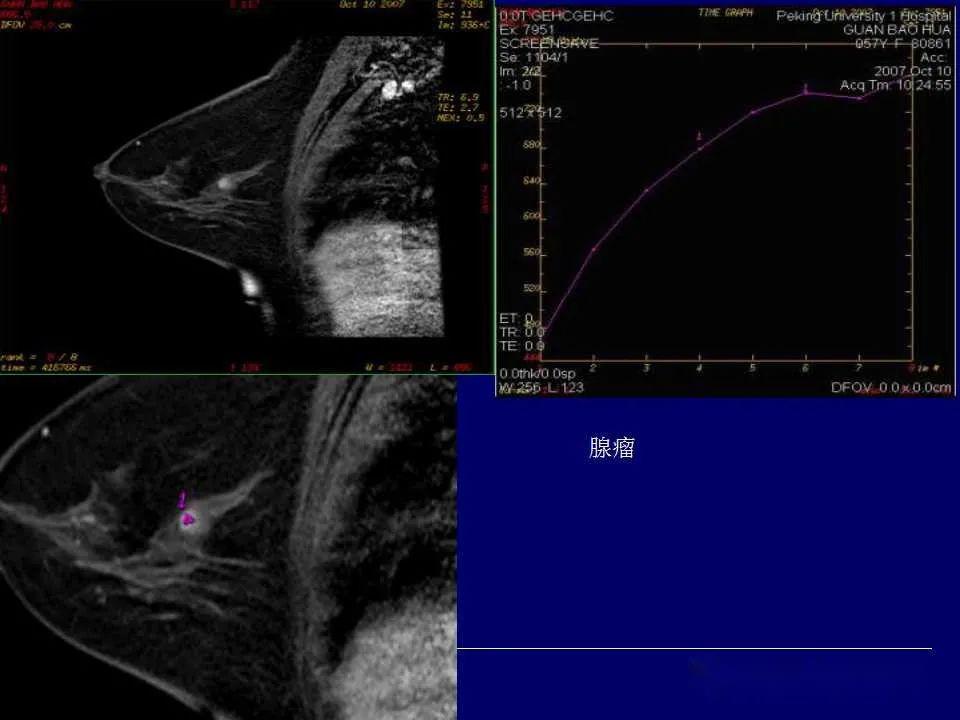 瞭解磁共振是如何診斷乳腺癌的